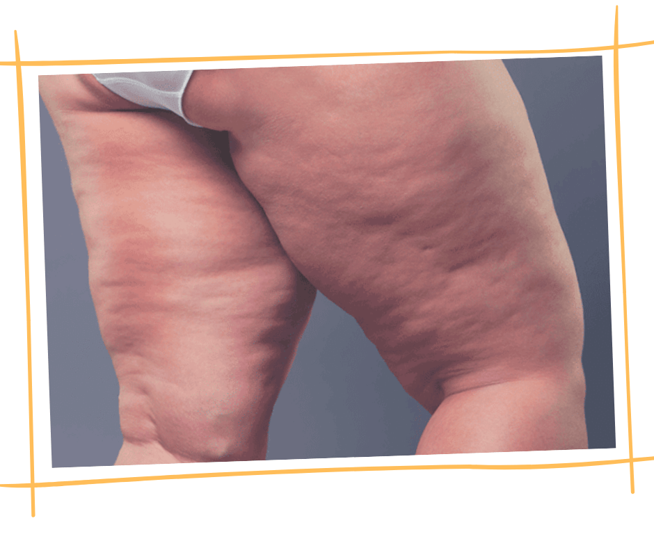 Com LIPEDEMA - corpo e mente sãos - Drenaclinic