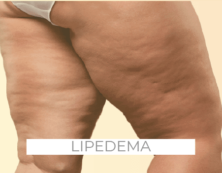 tratamentos lipedema drenaclinic lisboa